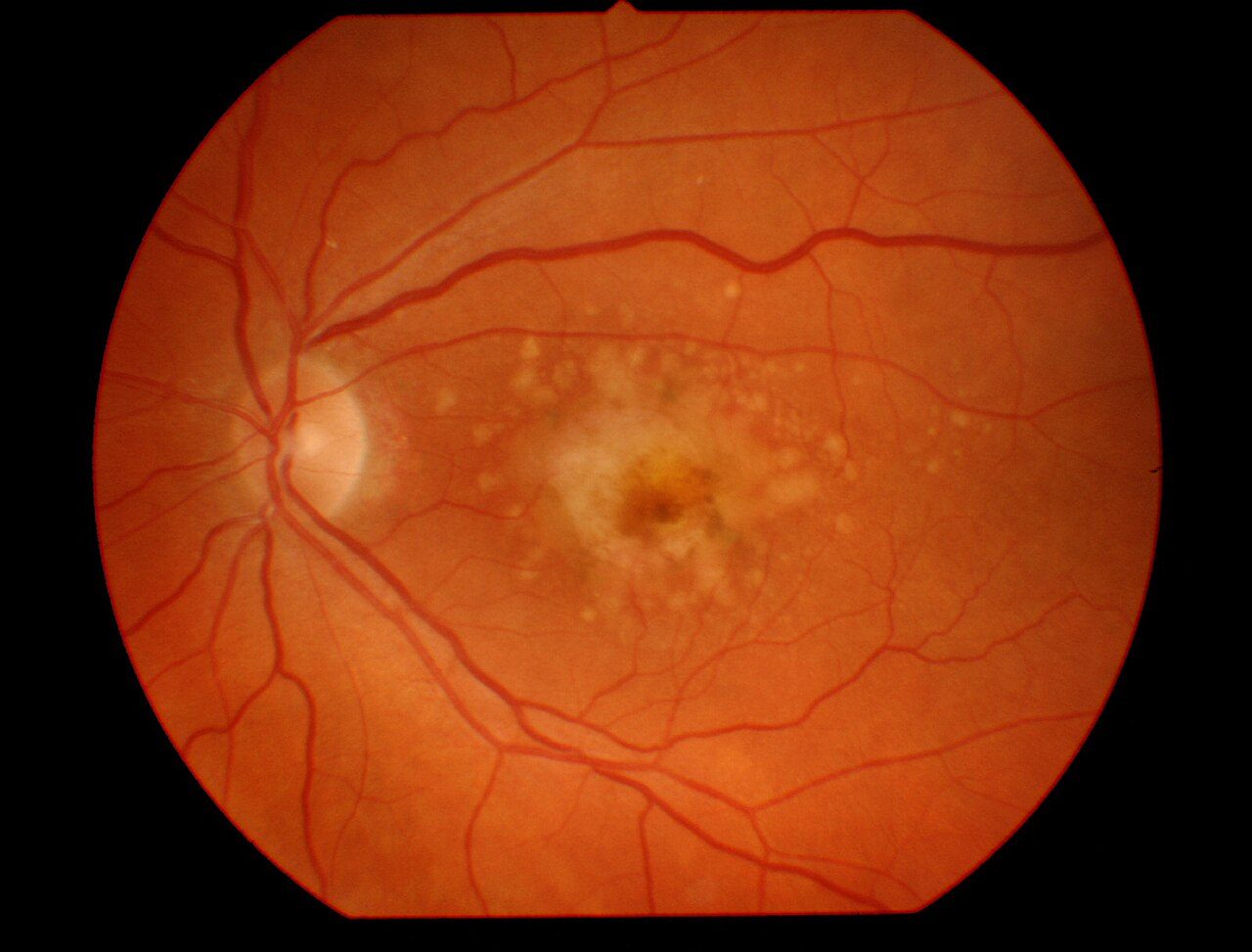 Fundus photograph showing age-related macular degeneration with drusen