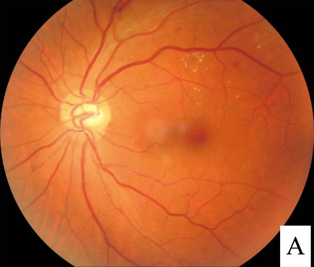 Fundus photograph showing diabetic retinopathy with macular edema and hemorrhages