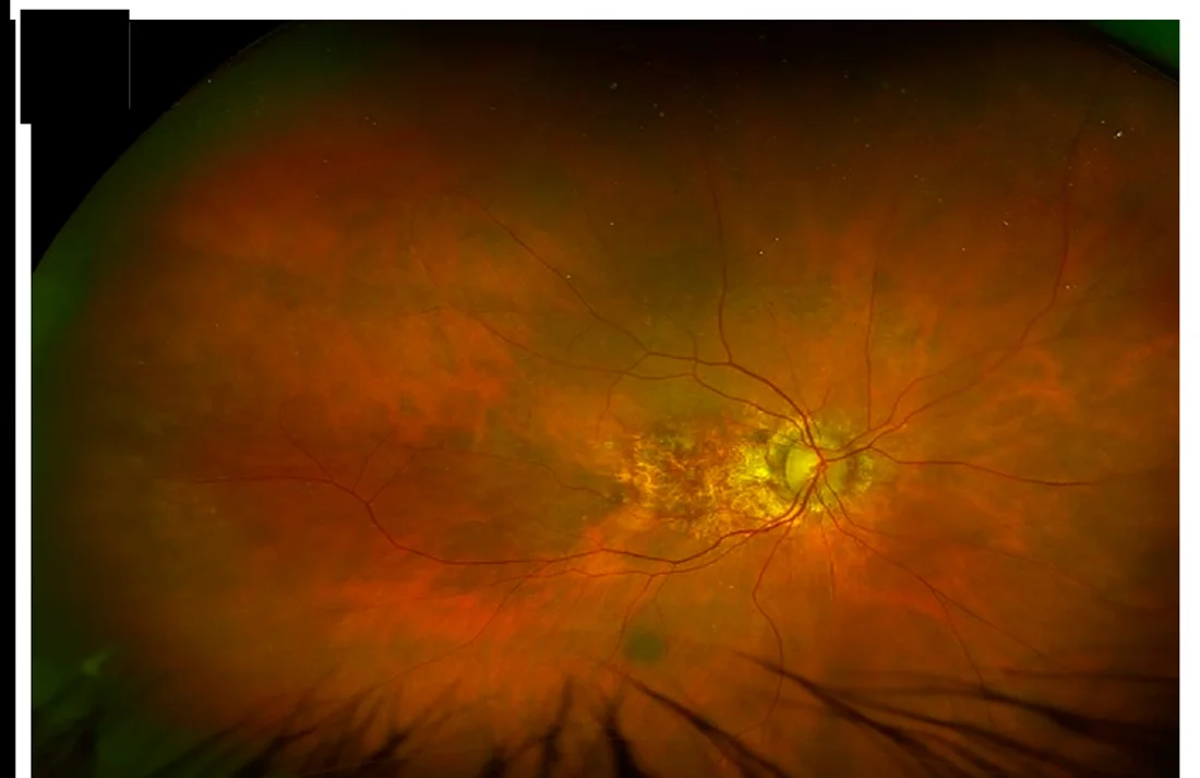 An ultra-widefield optomap photograph of the retina showing signs of macular degeneration — the wide panoramic view an optometrist reviews, with the optic nerve, blood vessels, and the affected macula visible.